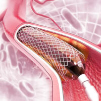 Angioplastia Arterial Periférica